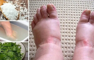 Remedios caseros para los pies hinchados