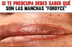 Quitar los granos de los labios y manchas de la cara