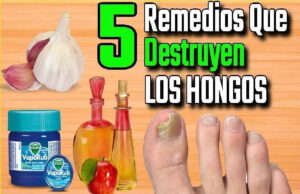 5 remedios naturales para tratar los hongos
