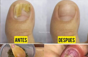 Bicarbonato de sodio para tratar los hongos en las uñas